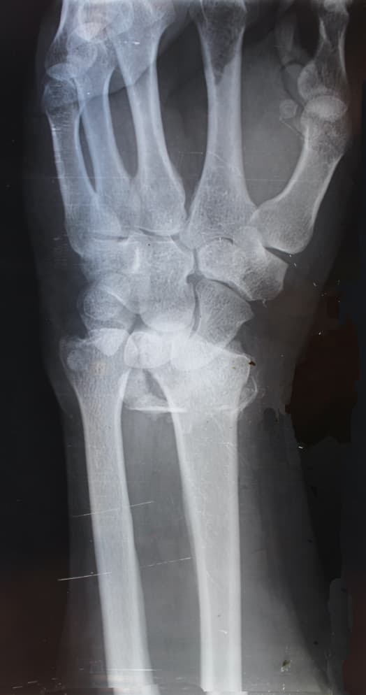 wrist xray