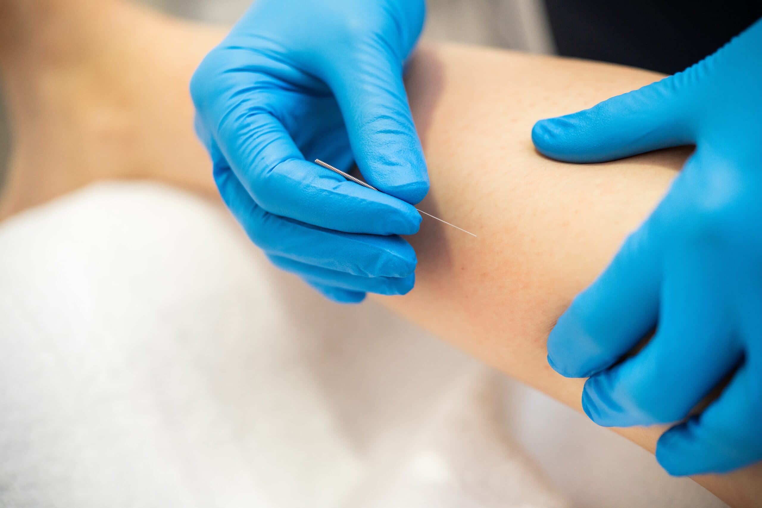a doctor performing acupuncture